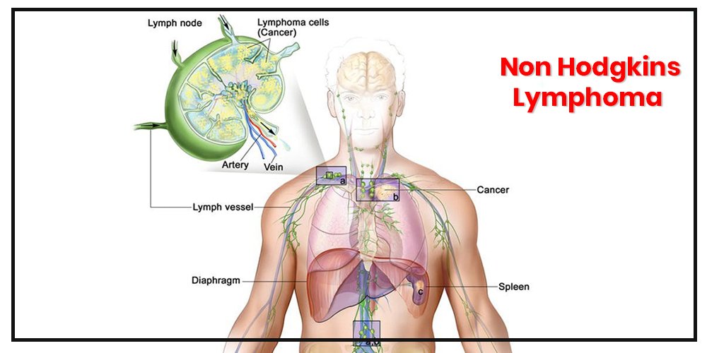 Read more about the article Non-Hodgkin’s Lymphoma
